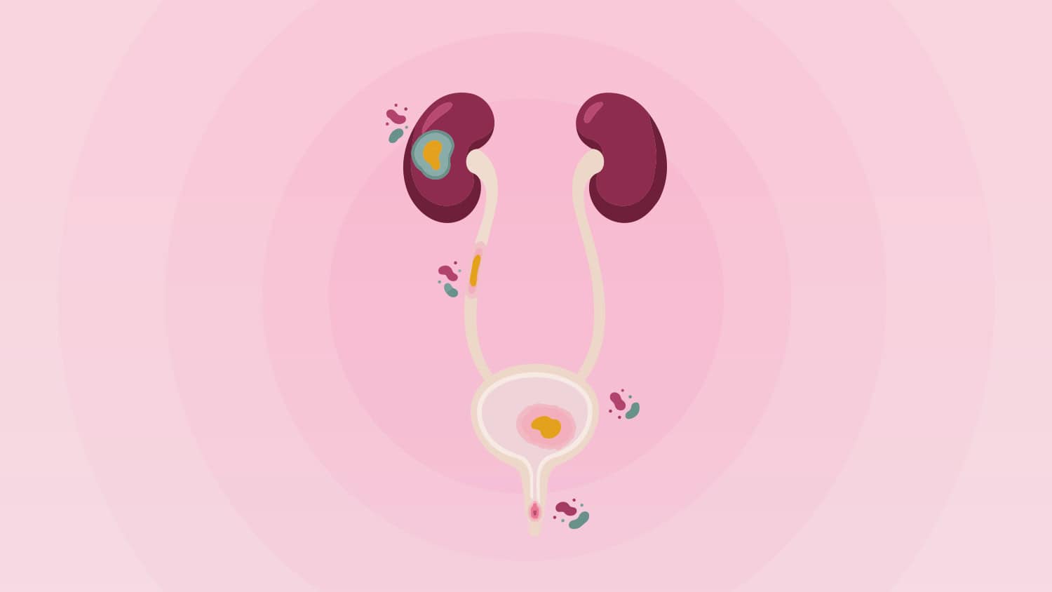 Do I Have a UTI? Signs, Causes, and Treatment